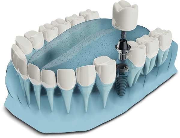 denal implant graphic