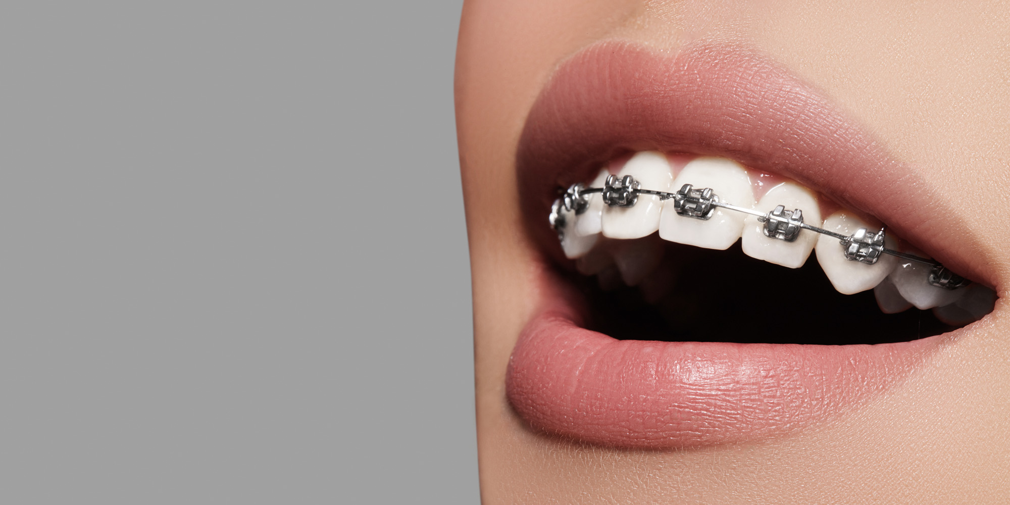 Orthodontic Braces Denver, NC Avason Family Dentistry