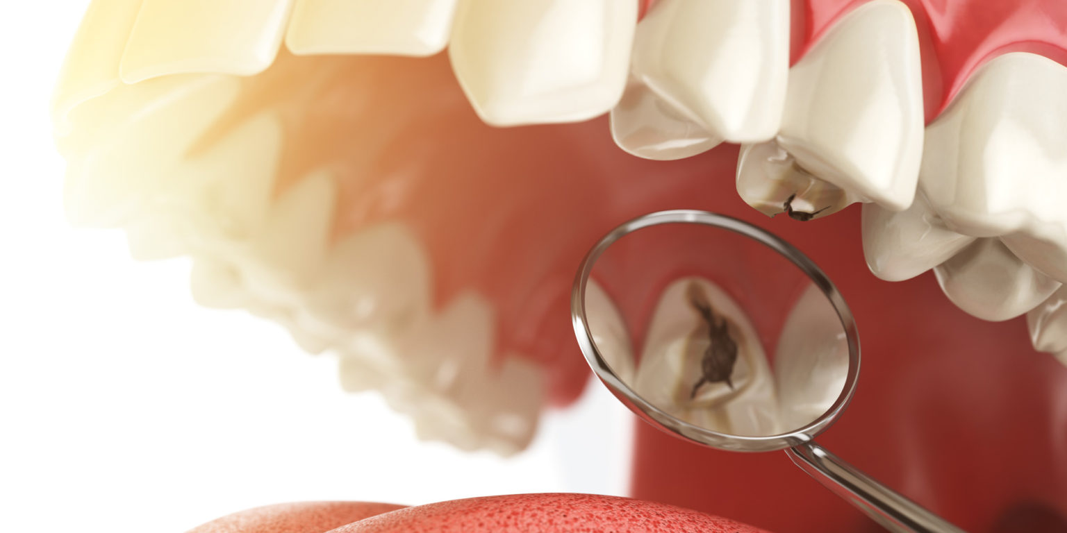 Cavity Fillings Denver, NC Avason Family Dentistry