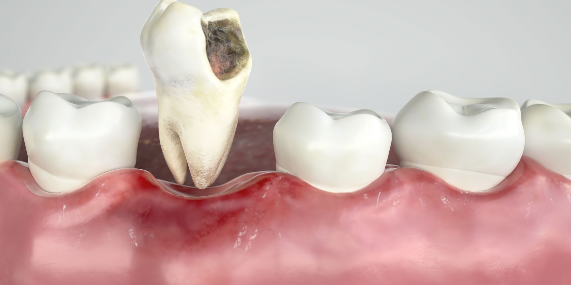 Will a Decayed Tooth Fall Out? Don't Wait for It, Act Now!