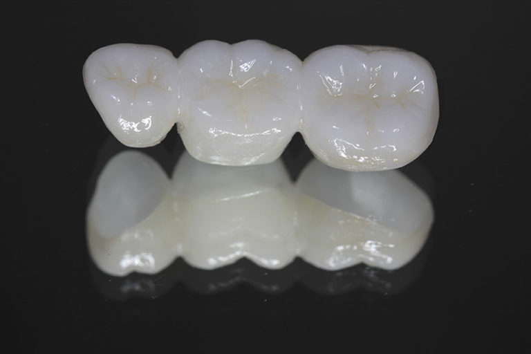Zirconia Fixed Bridges Avason Family Dentistry