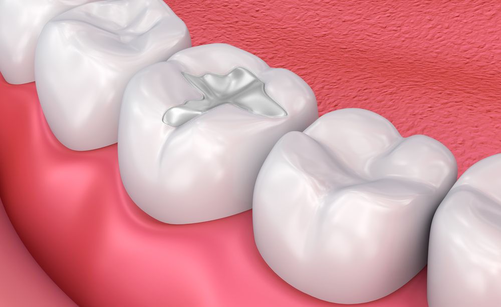 Composite Fillings