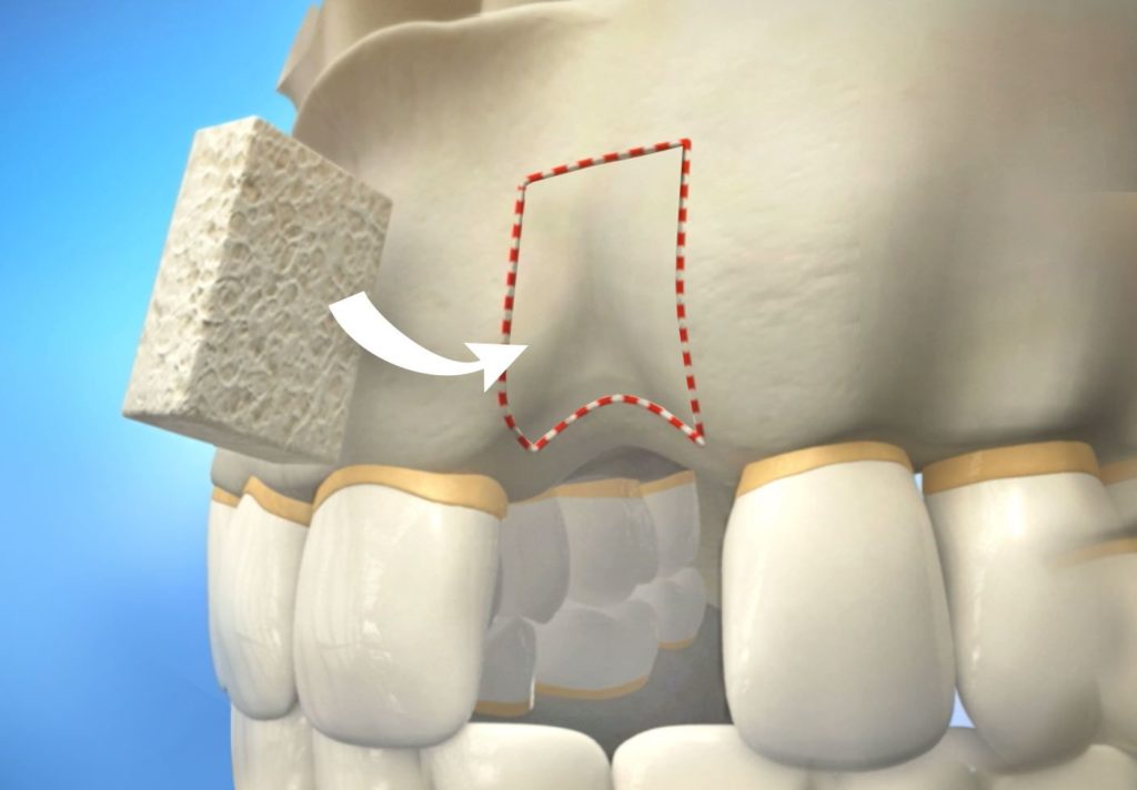 Bone Grafting Recovery Avason Family Dentistry Bone Grafting Recovery Avason Family Dentistry