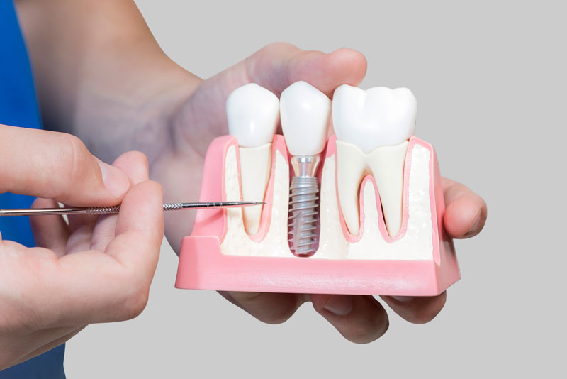Dental Assistant Showing Off A Dental Implant In A Jawbone Cutaway Model in Denver, NC