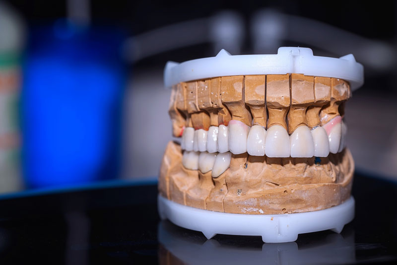 a full mouth dental implant model with dental crowns and a dental bridge.